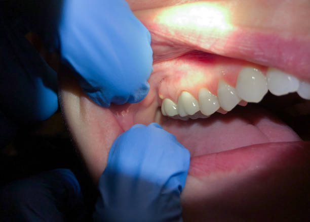 Best Emergency Dental Extractions in St Clair, PA